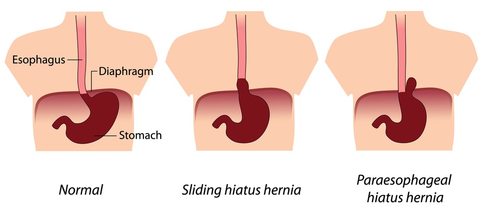 Hiatal Hernia Riverside Surgical Weight Loss Center Llc