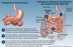 Duodenal Switch surgery, Biliopancreatic Diversion with Duodenal